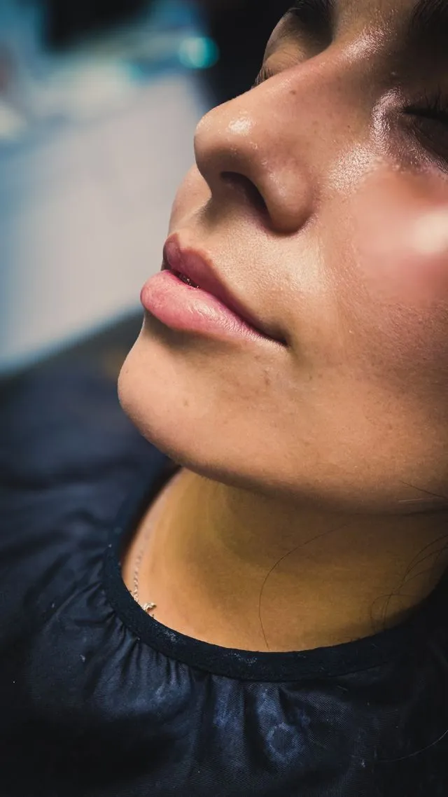 Resultado de armonización de labios con ácido hialurónico